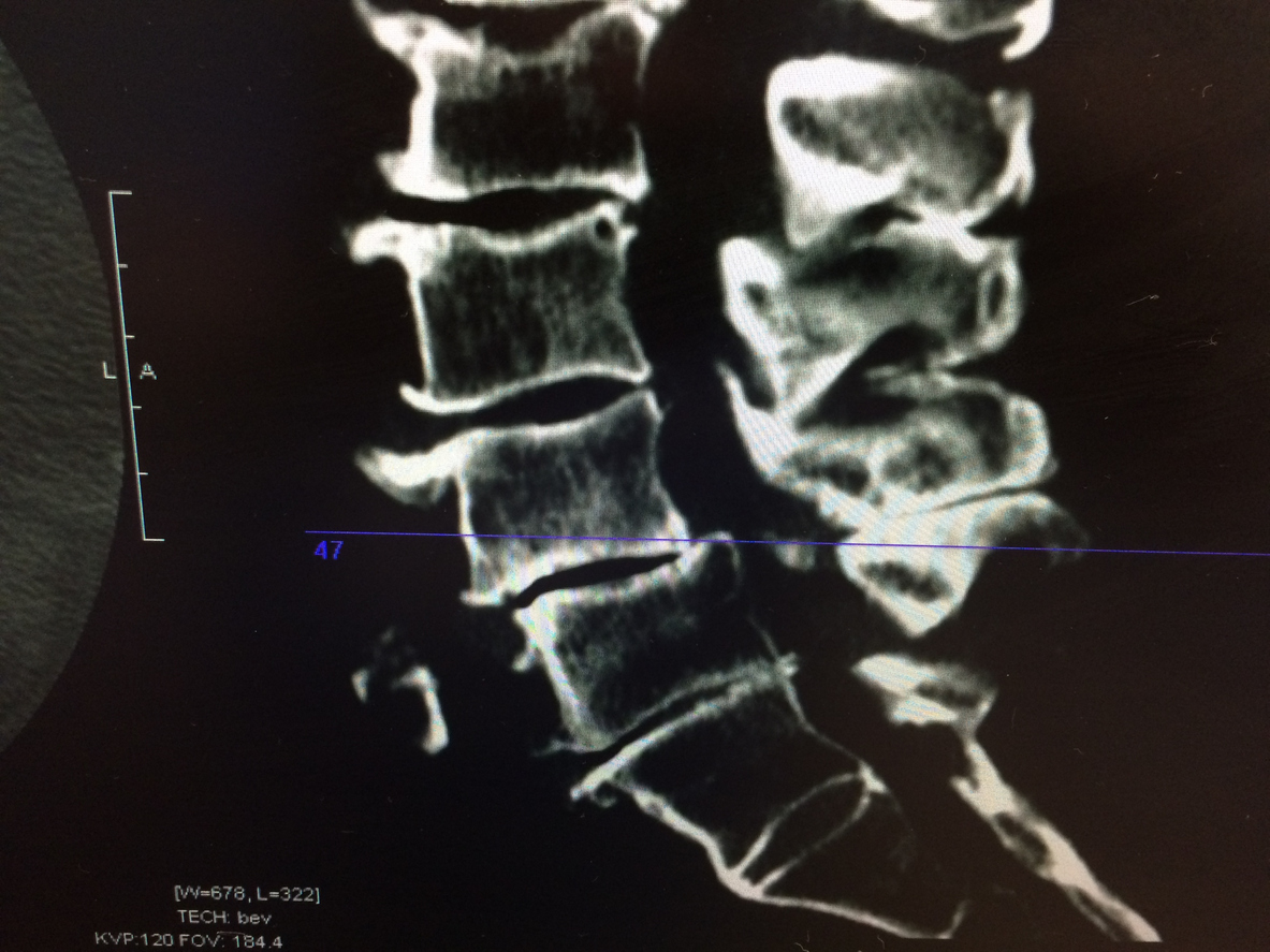 CT scan lumbar spine shows severe stenosis and degeration